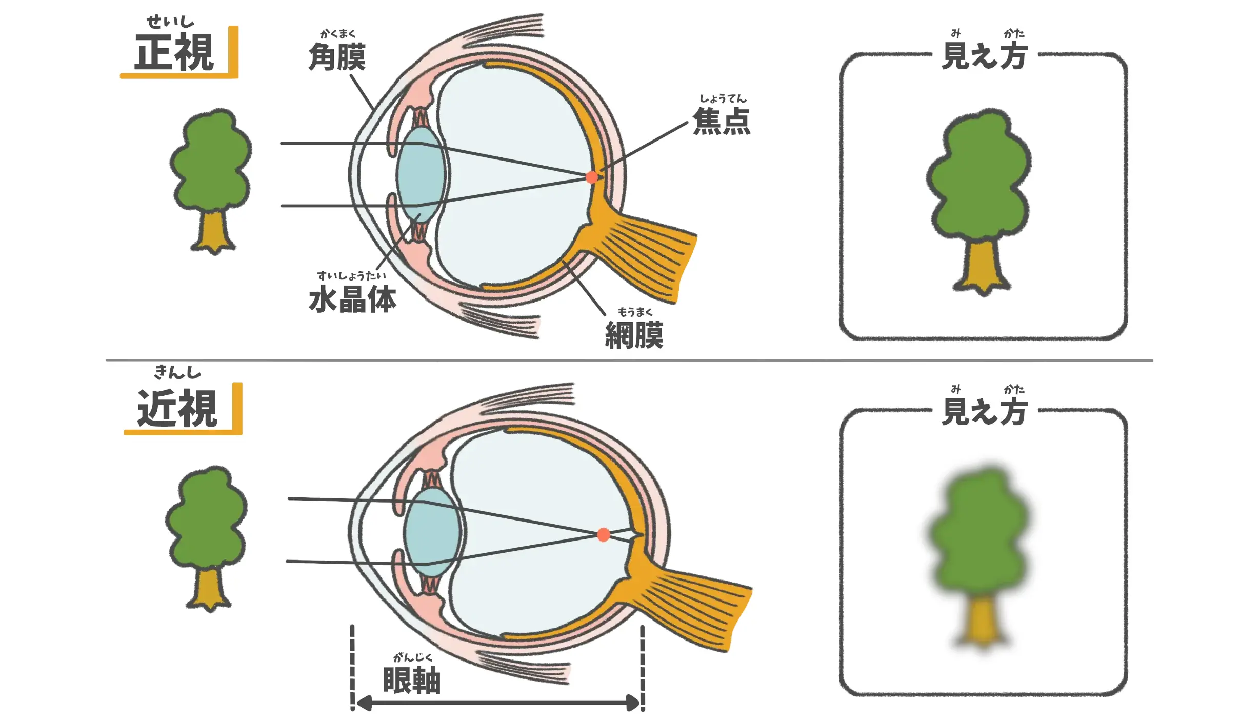 軸性近視