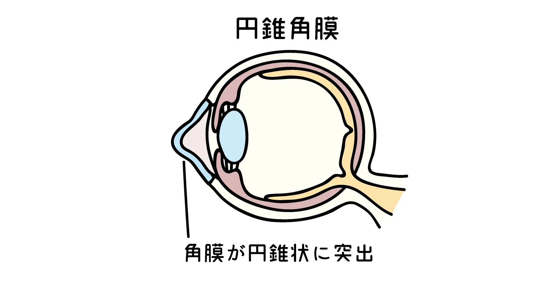 円錐角膜